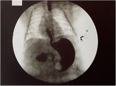 Long-gap esophageal atresia: is native esophagus preservation always possible?